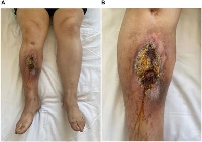 Optimizing diagnosis and surgical decisions for chronic osteomyelitis through radiomics in the precision medicine era